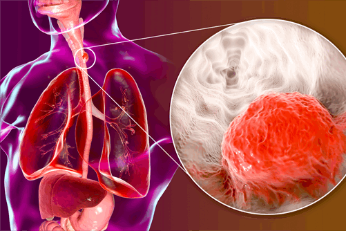 Esophageal Cancer