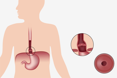 Hiatal Hernia